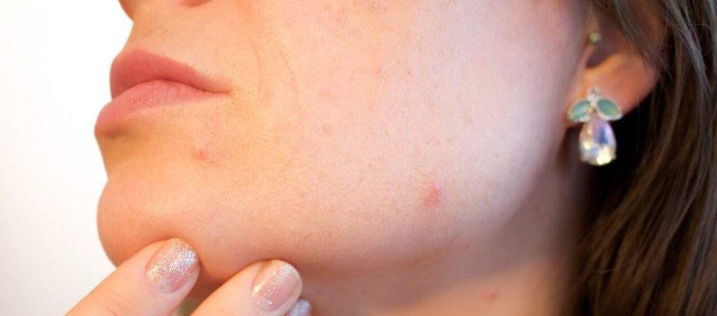 Glycolic Acid Acne Treatment