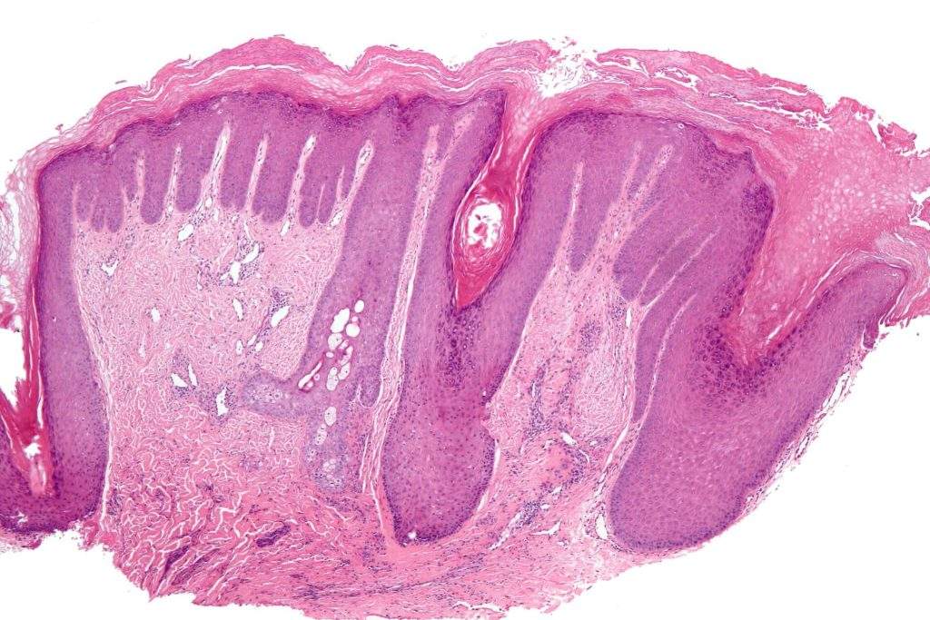 Hyperkeratosis micrograph