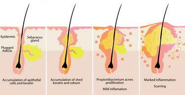 Acne formation