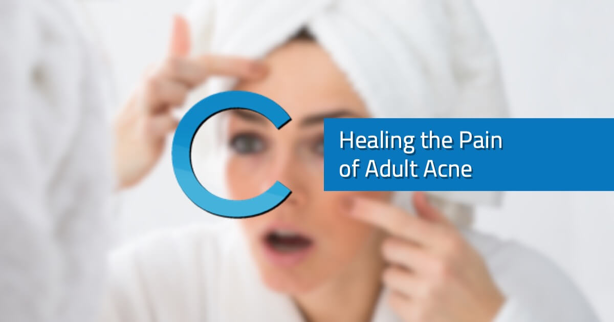 Healing the Pain of Adult Acne