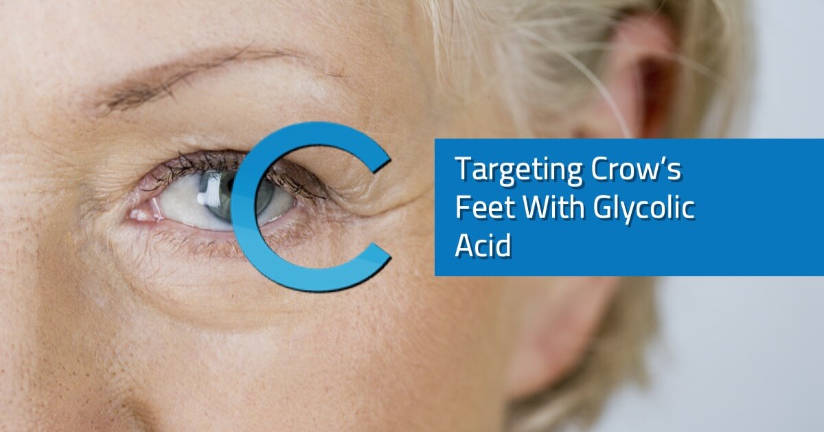Targeting Crow’s Feet With Glycolic Acid