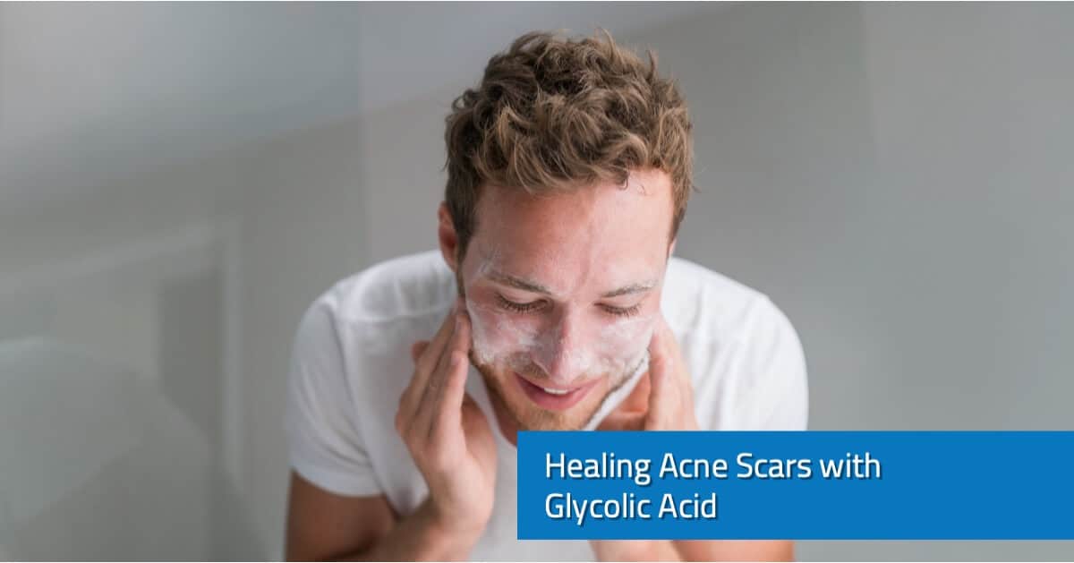 Healing Acne Scars with Glycolic Acid