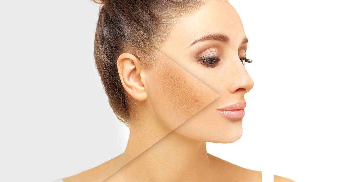 Hyperpigmentation Glycolic Acid Coast Southwest